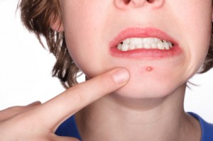 Pimple TCA Skin Peel: At Home or in the Office?
